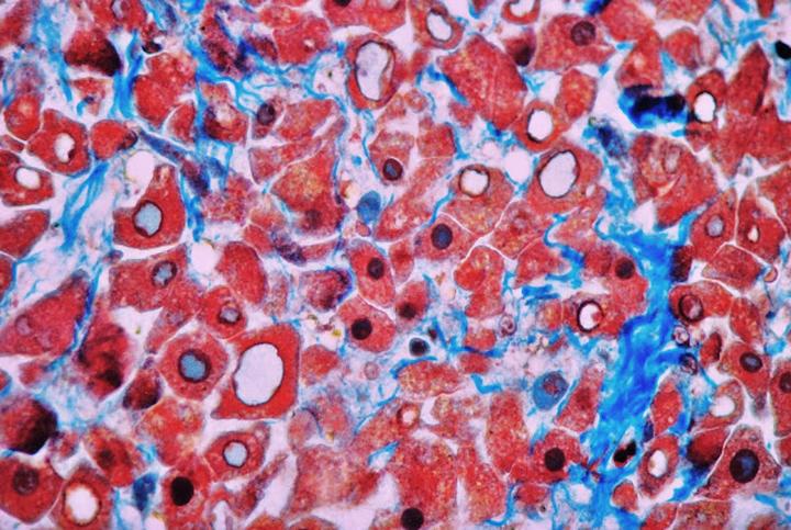 Co robić w przypadku złego wyniku badania histopatologicznego po łyżeczkowaniu? Przyczyny i dalsze kroki