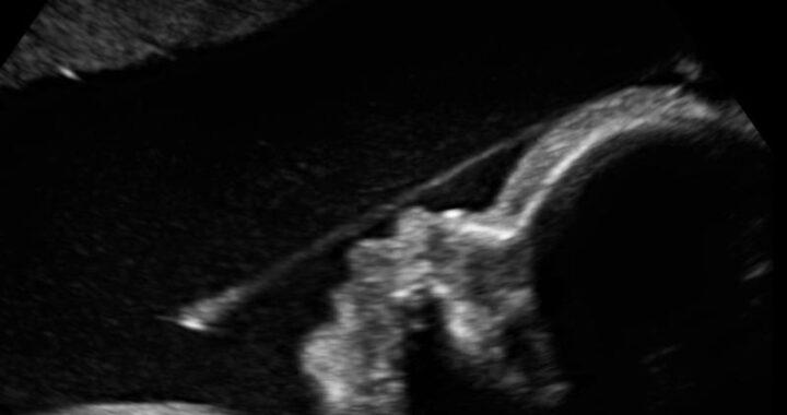 Tasma owodniowa w ciąży: jak rozpoznać, leczyć i jakie ma skutki dla zdrowia dziecka?