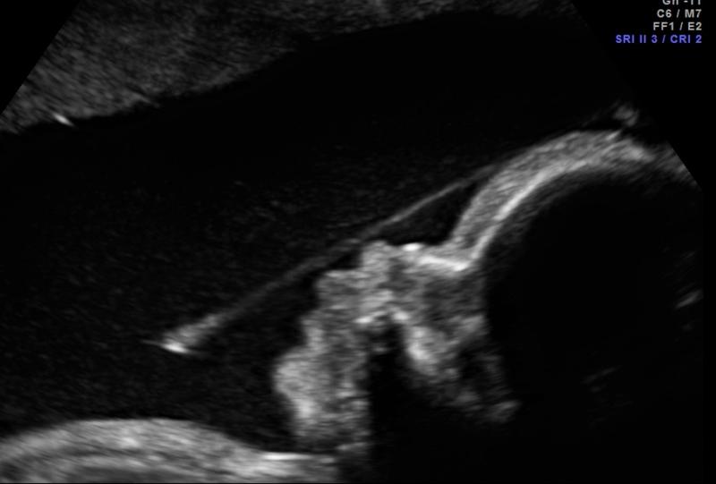 Tasma owodniowa w ciąży: jak rozpoznać, leczyć i jakie ma skutki dla zdrowia dziecka?