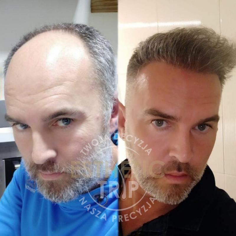 Lider rynku przeszczepów włosów