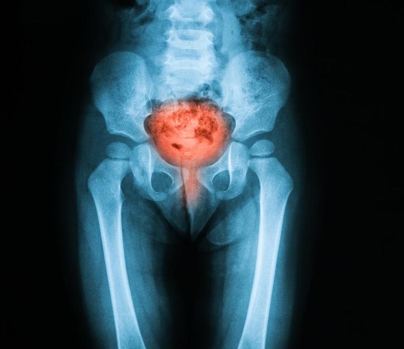 Naturalne metody leczenia pęcherza