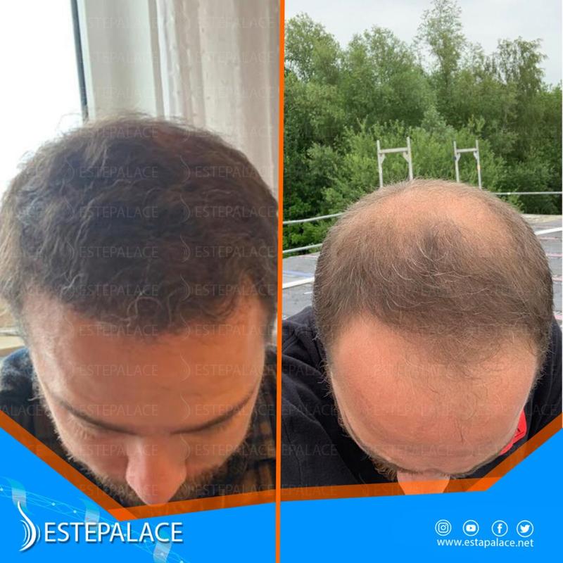 Transplantacja włosów