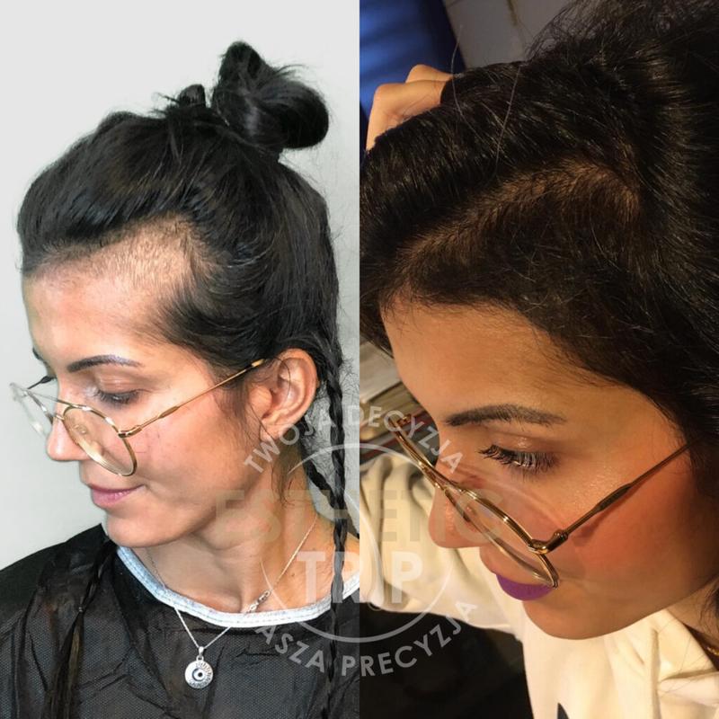 Zakola u mężczyzn i kobiet