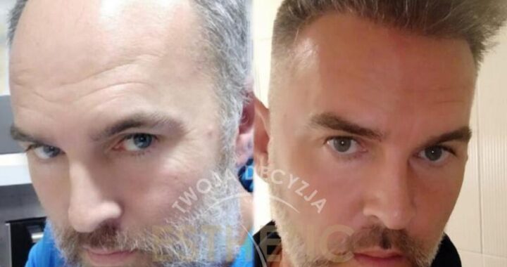 Skuteczne rozwiązanie dla mężczyzn i kobiet: Przeszczep włosów na zakola w Turcji