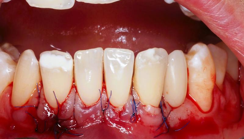 Recesja dziąseł profilaktyka i terapia