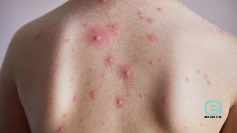 Pielęgnacja skóry dziecka po ospie wietrznej