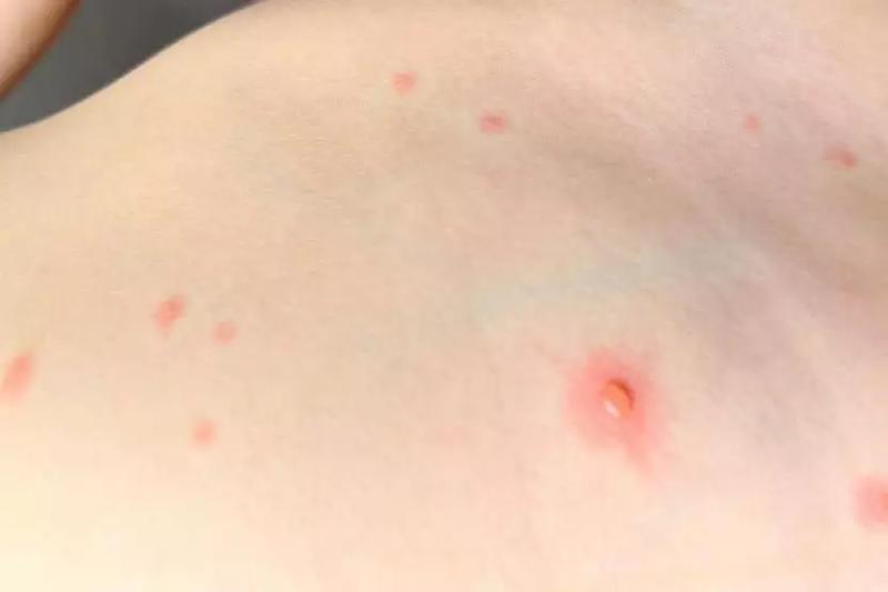 Powrót do przedszkola po ospie wietrznej