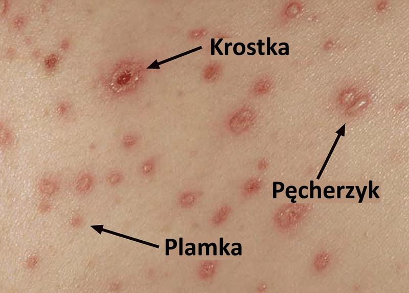 Znaki i objawy ospy wietrznej u dzieci
