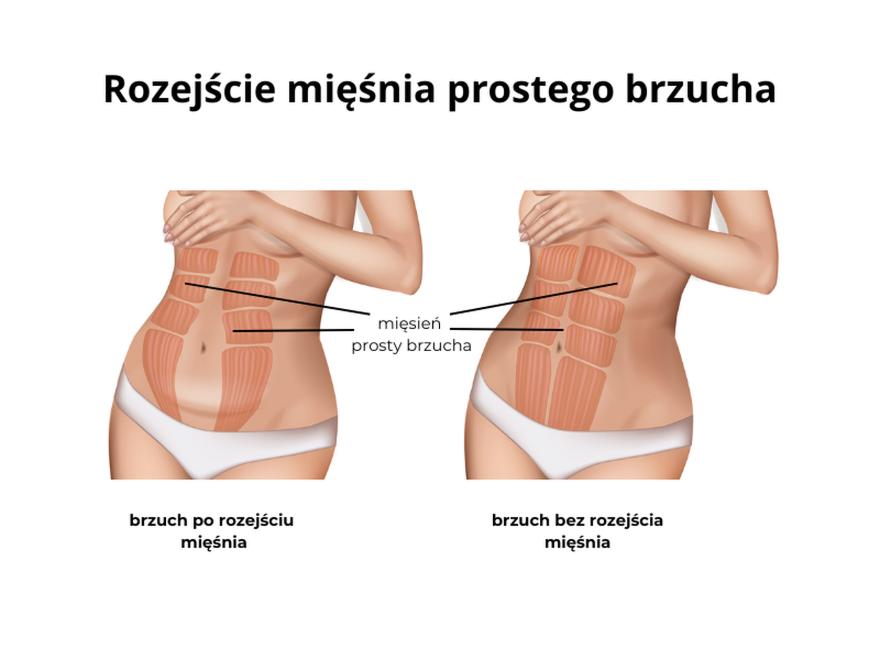 Ból mięśni w ciąży
