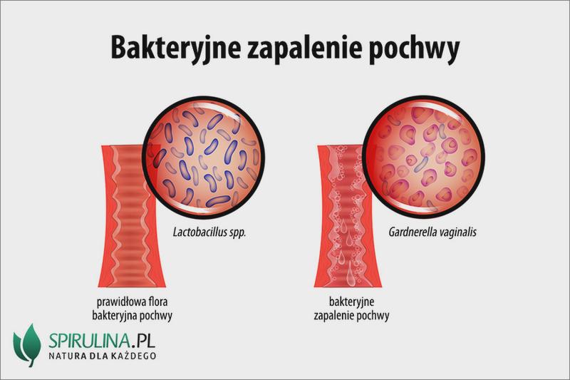 Leczenie infekcji intymnych w ciąży