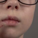 Czy dziecko z opryszczką może iść do przedszkola? Kiedy lepiej zostać w domu