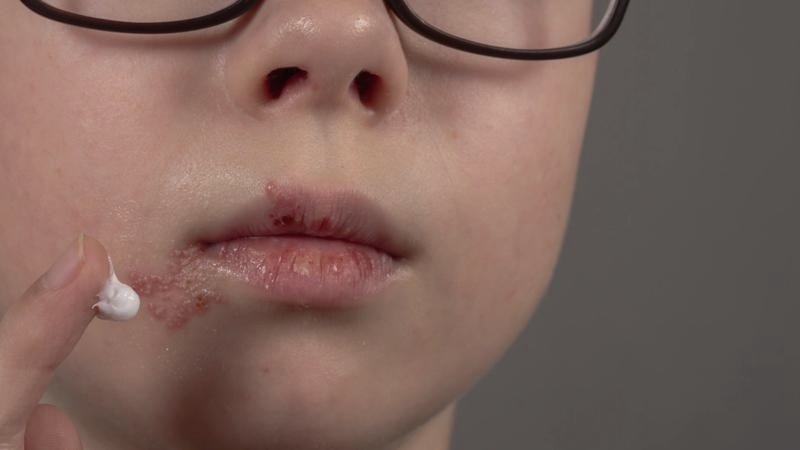 Czy dziecko z opryszczką może iść do przedszkola? Kiedy lepiej zostać w domu