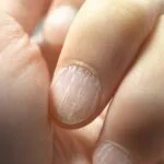 Dlaczego paznokcie pękają wzdłuż? Przyczyny i skuteczne sposoby pielęgnacji